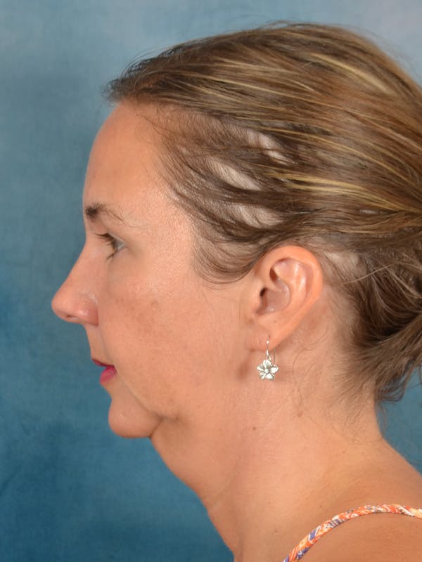 Deep Plane Facelift Before & After Gallery - Patient 129539 - Image 3