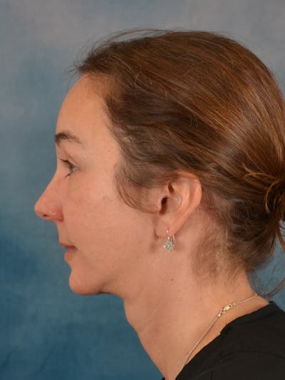 Brow Lift Before & After Gallery - Patient 443912 - Image 6