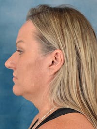 Rhinoplasty Before & After Gallery - Patient 388442 - Image 1
