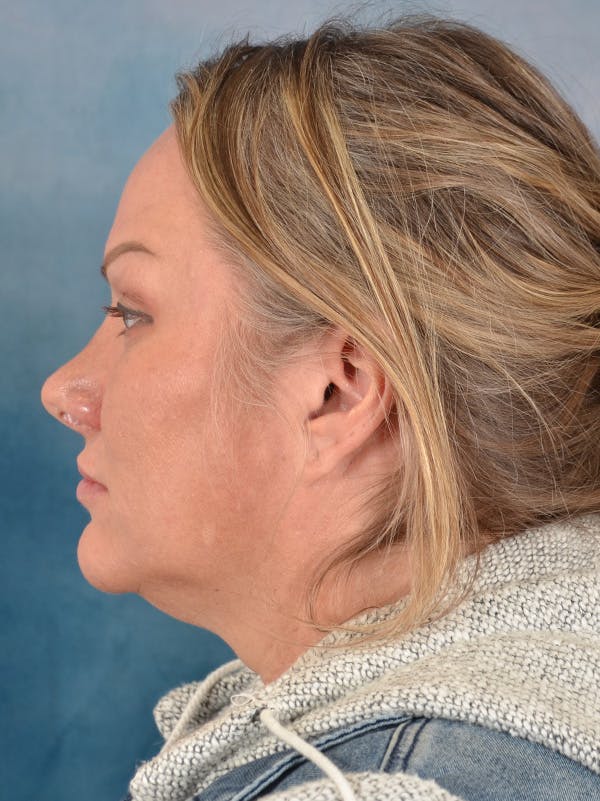 Rhinoplasty Before & After Gallery - Patient 388442 - Image 2