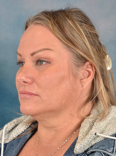 Rhinoplasty Before & After Gallery - Patient 388442 - Image 4