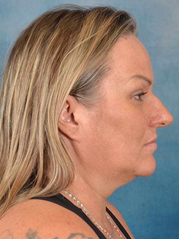 Rhinoplasty Before & After Gallery - Patient 388442 - Image 9