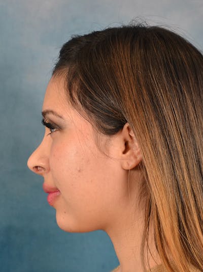 Rhinoplasty Before & After Gallery - Patient 329465 - Image 2