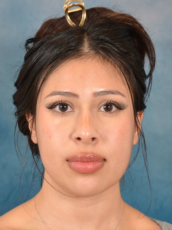 Rhinoplasty Before & After Gallery - Patient 329465 - Image 5