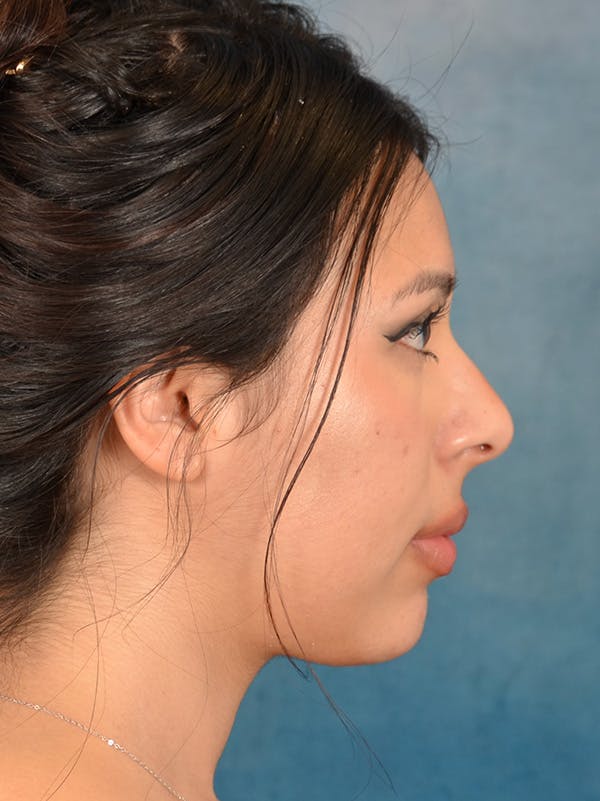 Rhinoplasty Before & After Gallery - Patient 329465 - Image 9