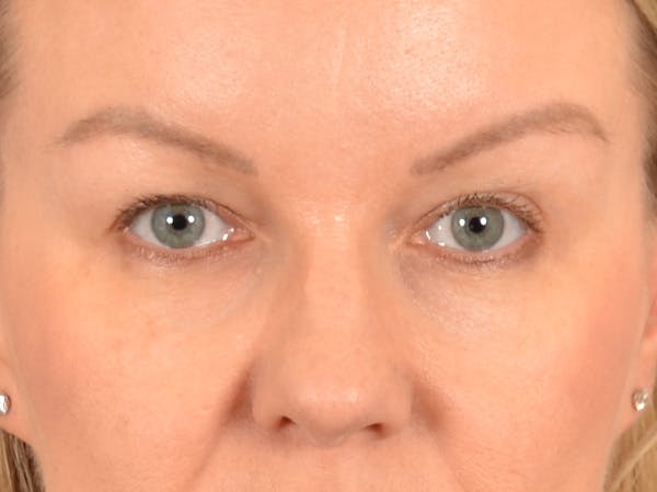 Eyelid Lift Before & After Gallery - Patient 427111 - Image 1