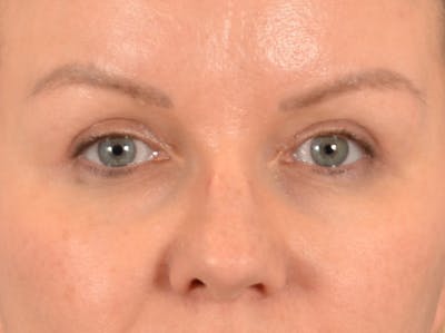 Eyelid Lift Before & After Gallery - Patient 427111 - Image 2
