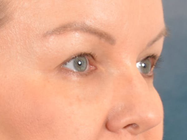 Eyelid Lift Before & After Gallery - Patient 427111 - Image 3