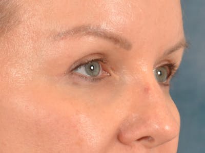 Eyelid Lift Before & After Gallery - Patient 427111 - Image 4
