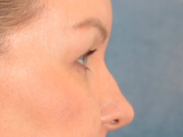 Eyelid Lift Before & After Gallery - Patient 427111 - Image 5