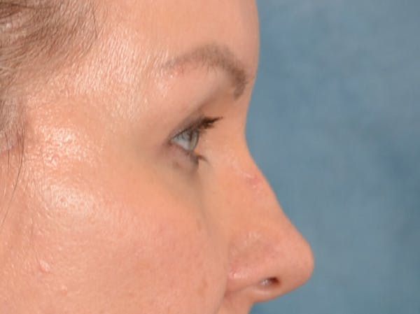 Eyelid Lift Before & After Gallery - Patient 427111 - Image 6