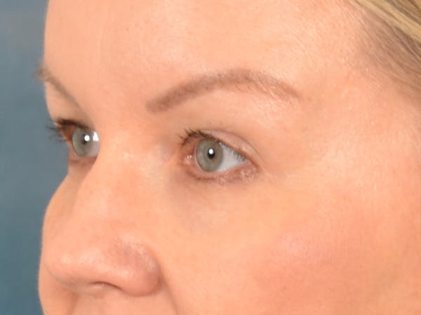 Eyelid Lift Before & After Gallery - Patient 427111 - Image 7