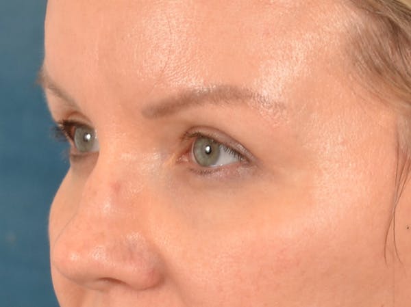 Eyelid Lift Before & After Gallery - Patient 427111 - Image 8