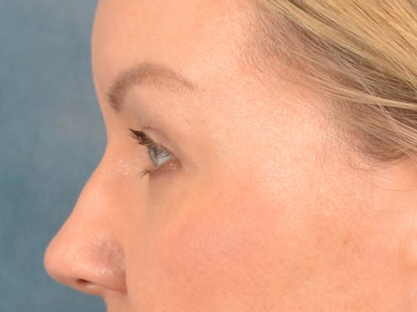 Eyelid Lift Before & After Gallery - Patient 427111 - Image 9