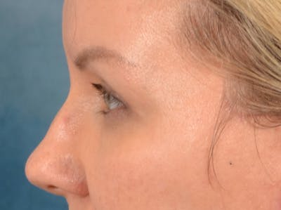 Eyelid Lift Before & After Gallery - Patient 427111 - Image 10