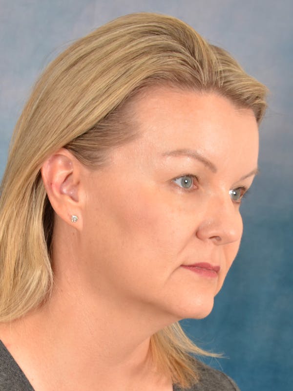 Deep Plane Facelift Before & After Gallery - Patient 413240 - Image 7
