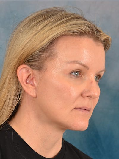 Deep Plane Facelift Before & After Gallery - Patient 413240 - Image 8