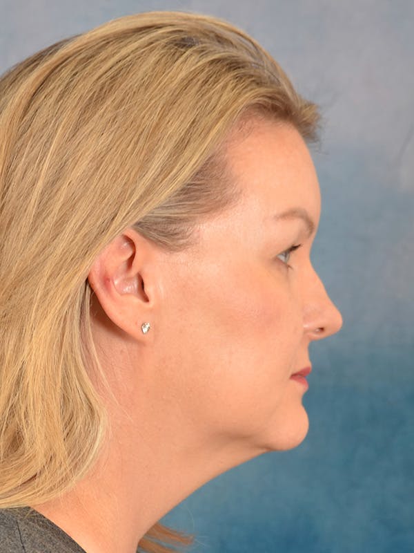 Deep Plane Facelift Before & After Gallery - Patient 413240 - Image 9
