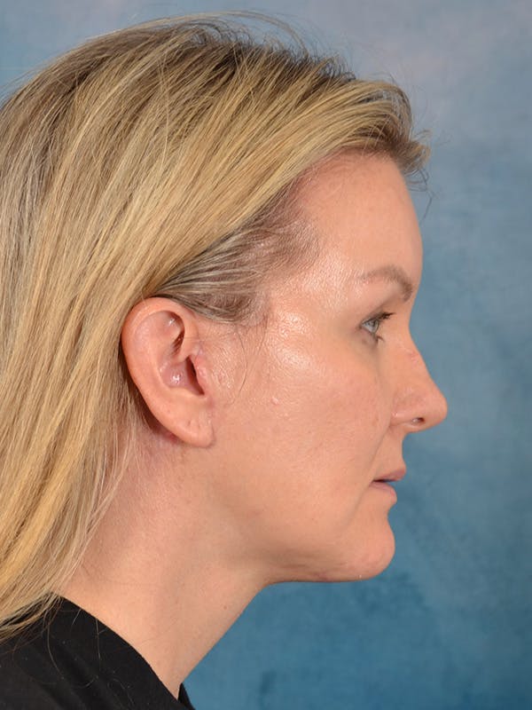 Deep Plane Facelift Before & After Gallery - Patient 413240 - Image 10