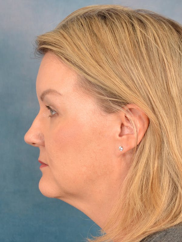Deep Plane Facelift Before & After Gallery - Patient 413240 - Image 3