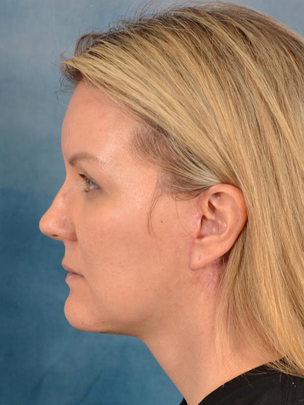 Deep Plane Facelift Before & After Gallery - Patient 413240 - Image 4