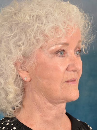 Laser Skin Resurfacing Before & After Gallery - Patient 183307 - Image 4