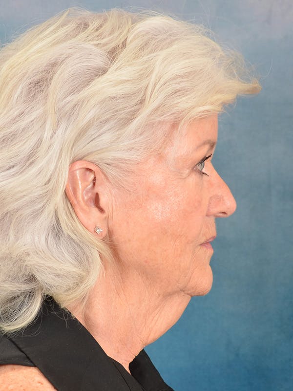 Laser Skin Resurfacing Before & After Gallery - Patient 183307 - Image 9