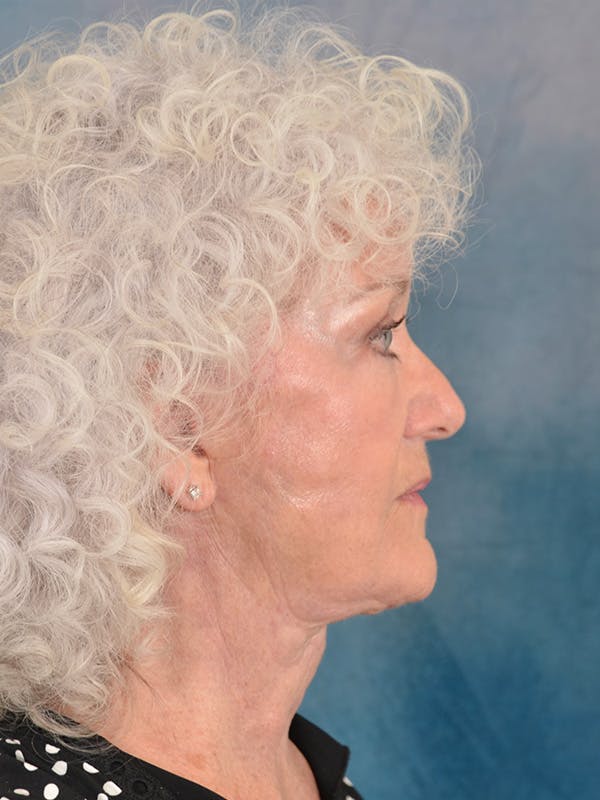 Deep Plane Facelift Before & After Gallery - Patient 399784 - Image 10