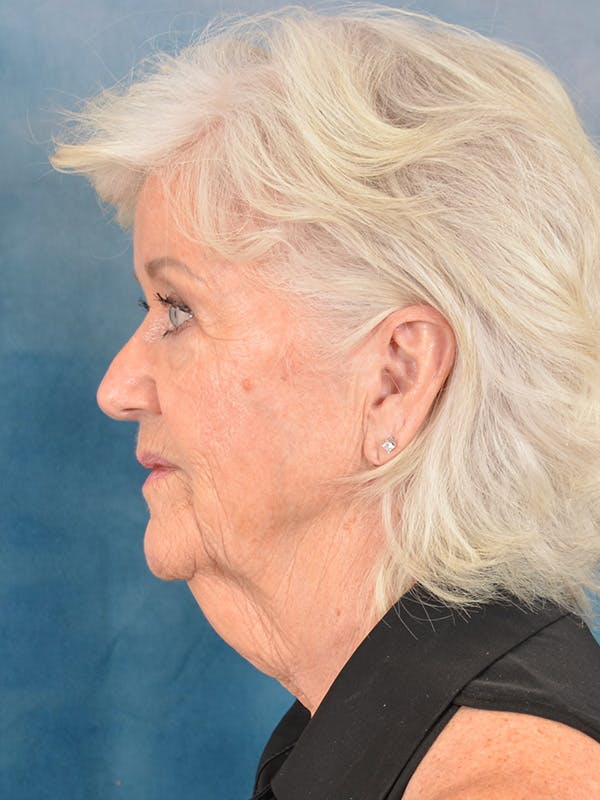 Laser Skin Resurfacing Before & After Gallery - Patient 183307 - Image 7