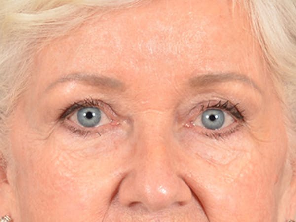 Brow Lift Before & After Gallery - Patient 682504 - Image 1