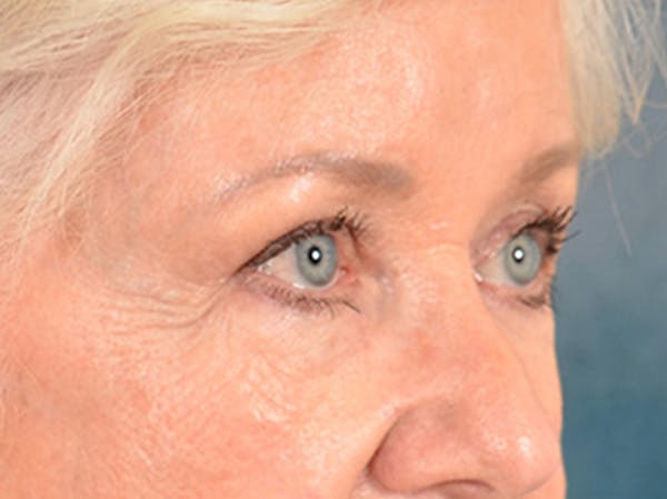 Brow Lift Before & After Gallery - Patient 682504 - Image 3
