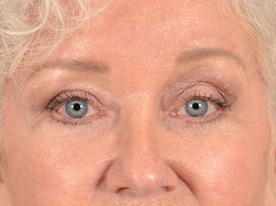 Brow Lift Before & After Gallery - Patient 682504 - Image 2