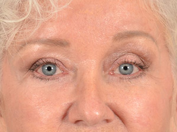 Brow Lift Before & After Gallery - Patient 682504 - Image 2
