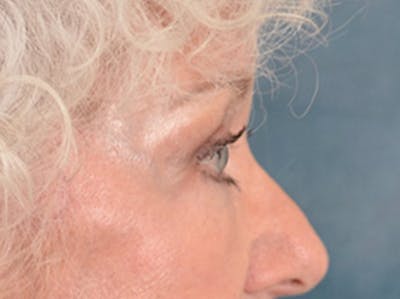 Eyelid Lift Before & After Gallery - Patient 243392 - Image 6