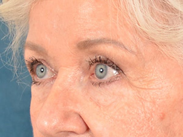 Eyelid Lift Before & After Gallery - Patient 243392 - Image 7
