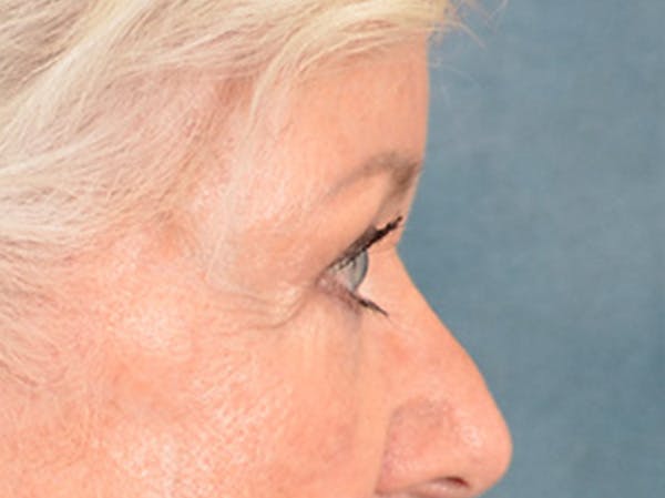 Eyelid Lift Before & After Gallery - Patient 243392 - Image 5