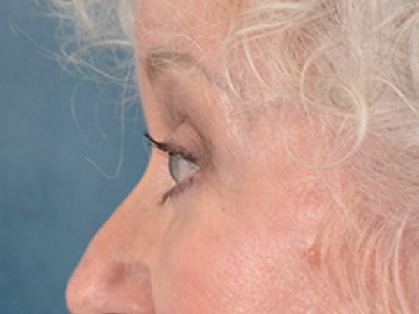 Brow Lift Before & After Gallery - Patient 682504 - Image 10