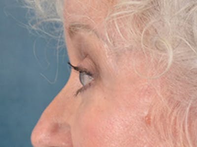 Brow Lift Before & After Gallery - Patient 682504 - Image 10