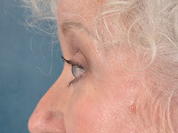 Eyelid Lift Before & After Gallery - Patient 243392 - Image 10
