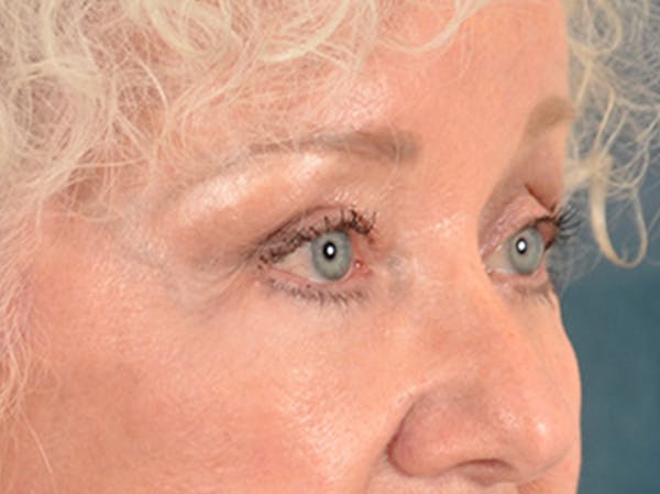 Brow Lift Before & After Gallery - Patient 682504 - Image 4