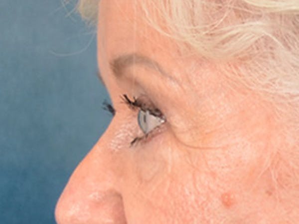 Brow Lift Before & After Gallery - Patient 682504 - Image 9