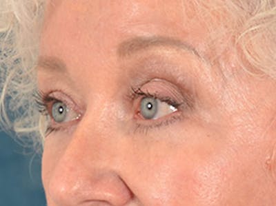 Brow Lift Before & After Gallery - Patient 682504 - Image 8