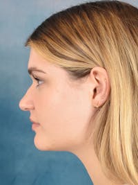 Rhinoplasty Before & After Gallery - Patient 181417 - Image 1