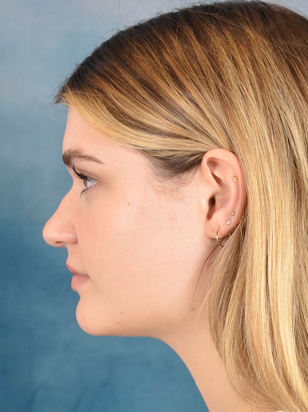 Rhinoplasty Before & After Gallery - Patient 181417 - Image 1