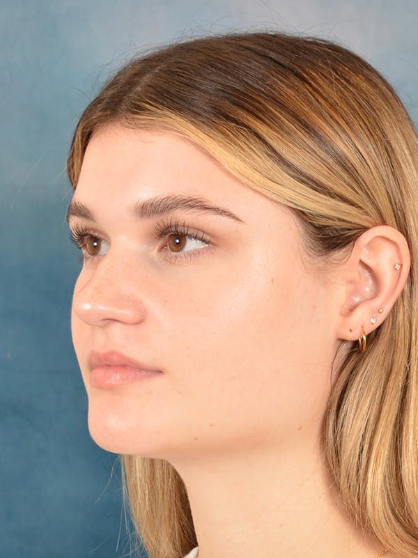 Rhinoplasty Before & After Gallery - Patient 181417 - Image 3