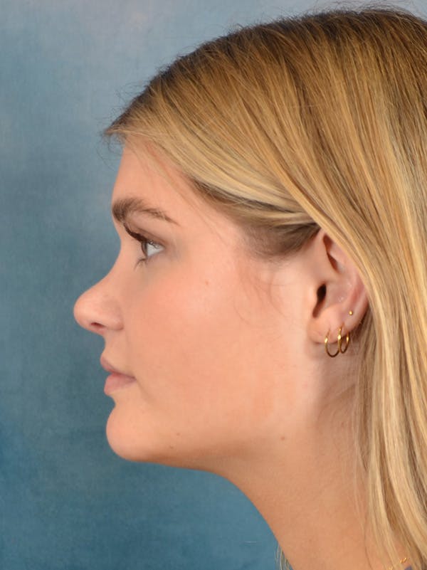Rhinoplasty Before & After Gallery - Patient 181417 - Image 2