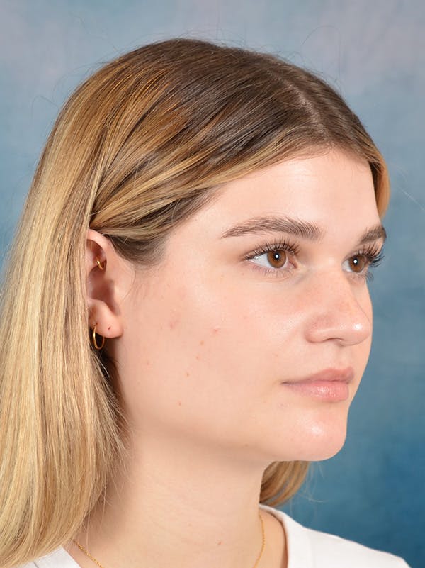 Rhinoplasty Before & After Gallery - Patient 181417 - Image 7