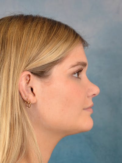 Rhinoplasty Before & After Gallery - Patient 181417 - Image 10