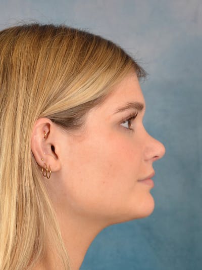 Rhinoplasty Before & After Gallery - Patient 181417 - Image 10