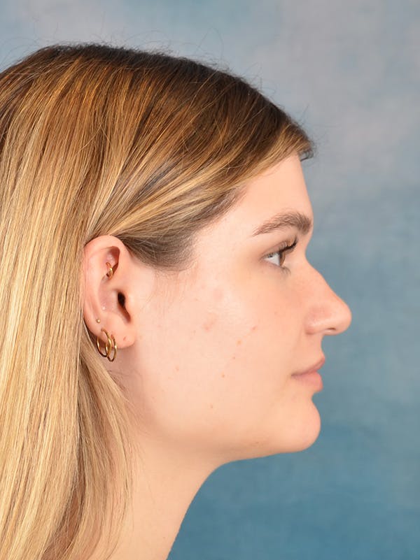 Rhinoplasty Before & After Gallery - Patient 181417 - Image 9